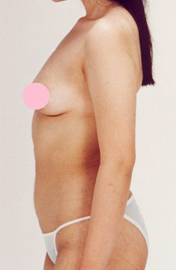 脂肪吸引,脂肪吸引の症例写真　腹部,After,ba_shibokyuin28_b.jpg