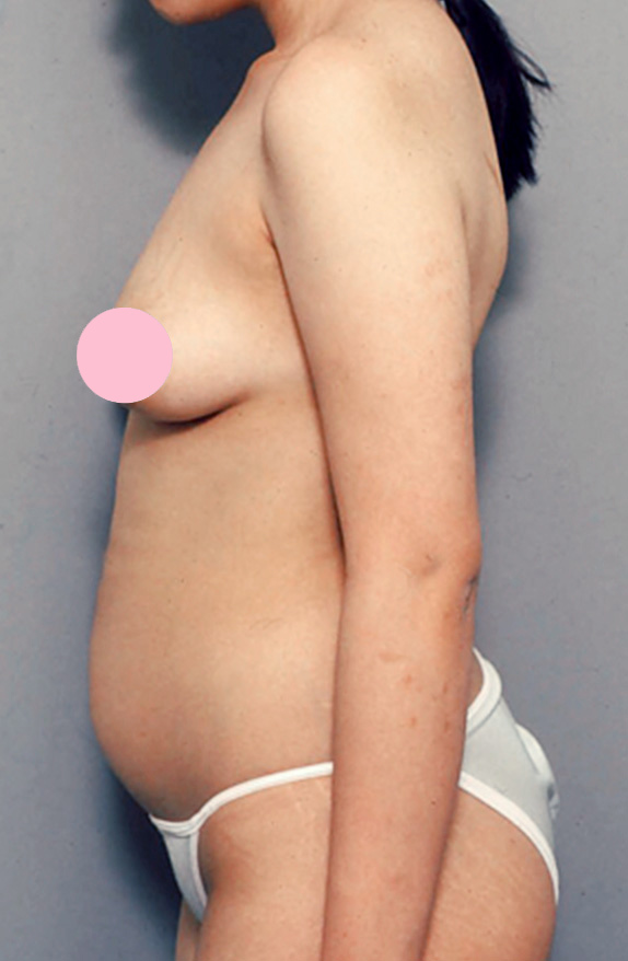 症例写真,脂肪吸引の症例写真　腹部,Before,ba_shibokyuin28_b.jpg