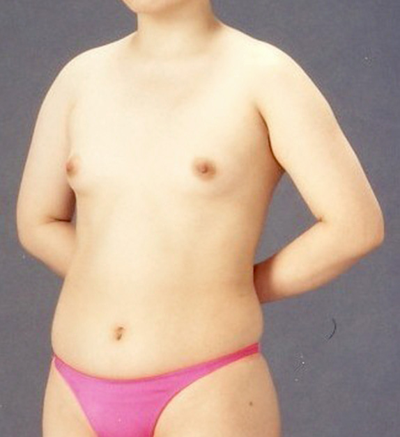 症例写真,脂肪吸引腹部の症例　ピュアコンデンス脂肪注入豊胸も施行,Before,ba_shibokyuin29_b.jpg