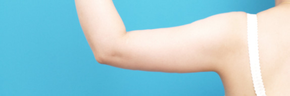 イタリアン・メソシェイプ（イタリアンメソセラピー）・脂肪溶解注射,イタリアン・メソシェイプ（イタリアンメソセラピー）・脂肪溶解注射の症例 二の腕を細くしたい30代女性,After,ba_meso26_a01.jpg