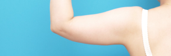イタリアン・メソシェイプ（イタリアンメソセラピー）・脂肪溶解注射の症例 二の腕を細くしたい30代女性,Before,ba_meso26_b.jpg