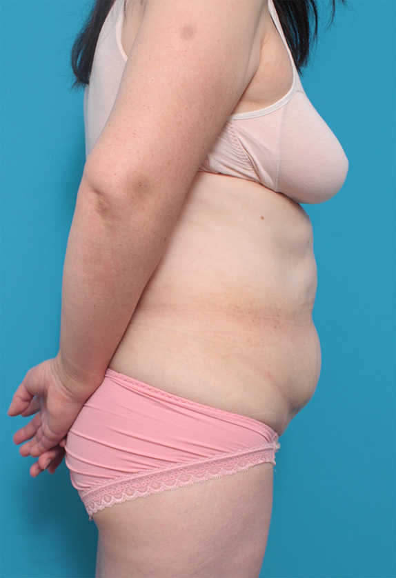 脂肪吸引,50代女性のたるんだお腹まわりに大量の脂肪吸引をした症例写真,Before,ba_shibokyuin67_b.jpg