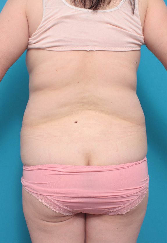 脂肪吸引,50代女性のたるんだお腹まわりに大量の脂肪吸引をした症例写真,Before,ba_shibokyuin68_b.jpg