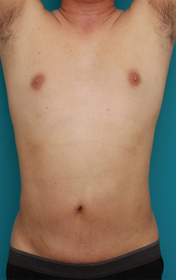 脂肪吸引,30代男性のお腹、わき腹、背中、腰の脂肪吸引をした症例写真,After（1年後）,ba_shibokyuin69_b.jpg