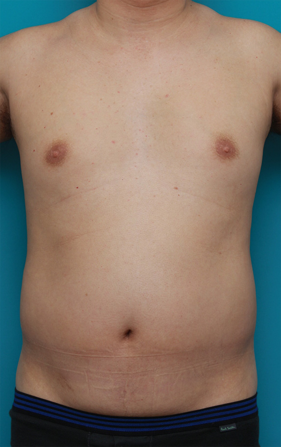 脂肪吸引,30代男性のお腹、わき腹、背中、腰の脂肪吸引をした症例写真,Before,ba_shibokyuin69_b.jpg