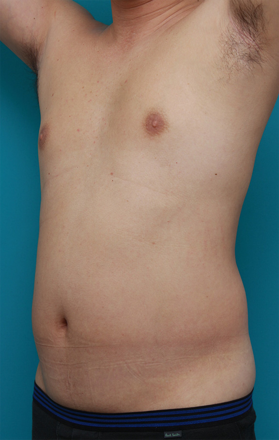 脂肪吸引,30代男性のお腹、わき腹、背中、腰の脂肪吸引をした症例写真,Before,ba_shibokyuin70_b.jpg