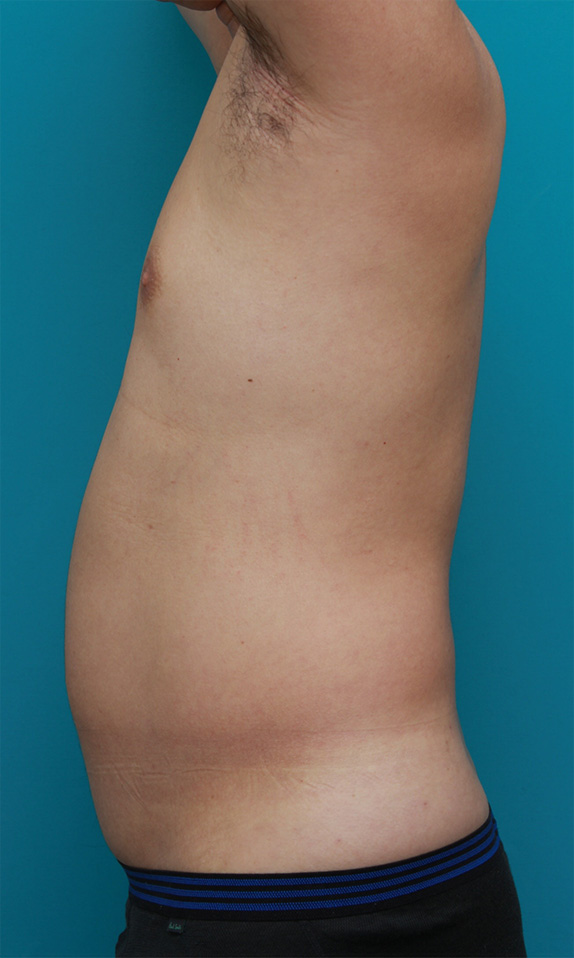 脂肪吸引,30代男性のお腹、わき腹、背中、腰の脂肪吸引をした症例写真,Before,ba_shibokyuin71_b.jpg