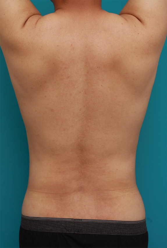 脂肪吸引,30代男性のお腹、わき腹、背中、腰の脂肪吸引をした症例写真,After（1年後）,ba_shibokyuin72_b.jpg