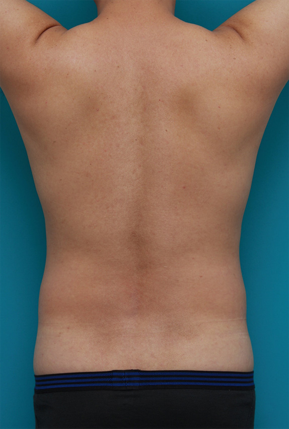 症例写真,30代男性のお腹、わき腹、背中、腰の脂肪吸引をした症例写真,Before,ba_shibokyuin72_b.jpg