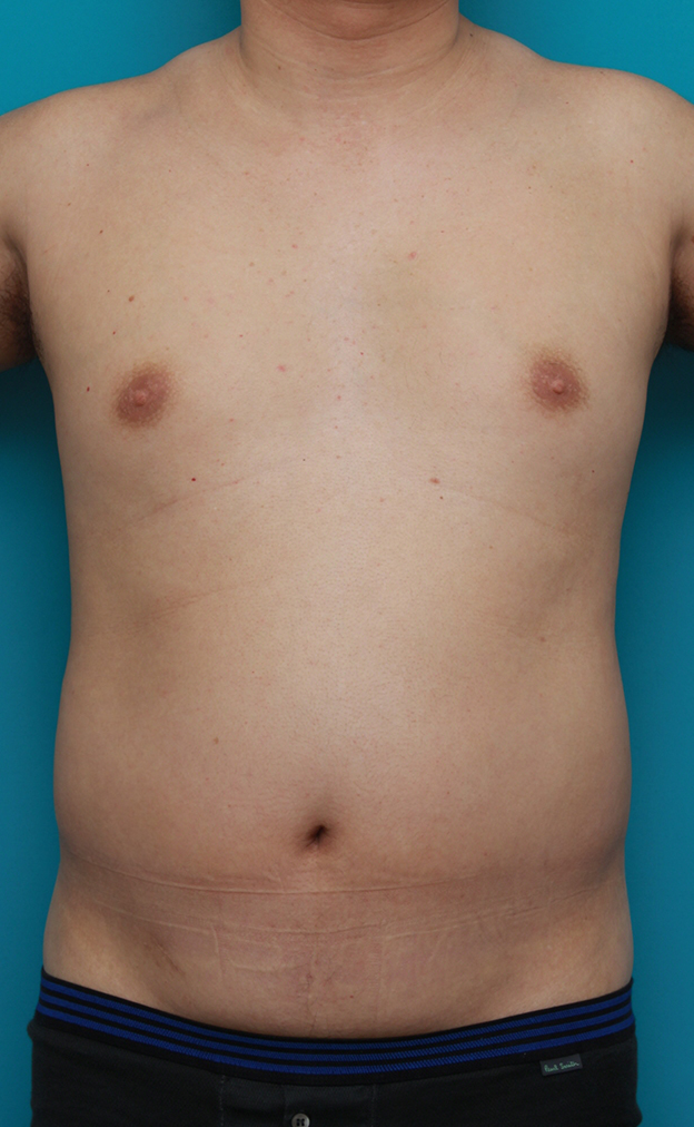 脂肪吸引,30代男性のお腹、わき腹、背中、腰の脂肪吸引をした症例写真,手術前,mainpic_shibokyuin01a.jpg