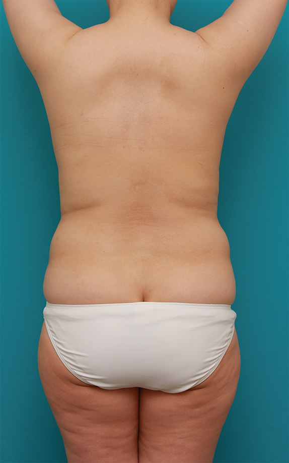 ピュアコンデンス脂肪注入豊胸,脂肪吸引の症例 バストを大きくして張りを出したい30代女性,Before,ba_shibokyuin76_b.jpg