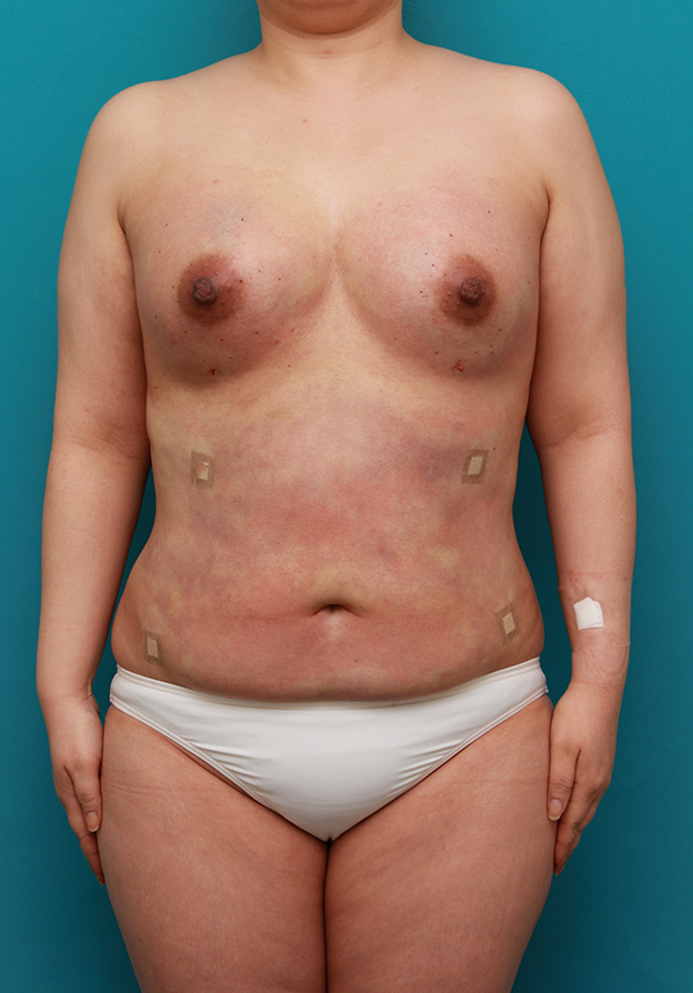 脂肪吸引,脂肪吸引の症例 バストを大きくして張りを出したい30代女性,手術直後,mainpic_shibokyuin02b.jpg