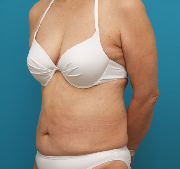 症例写真,イタリアン・メソシェイプ（イタリアンメソセラピー）・脂肪溶解注射の症例　おなか全体・ウエスト,After,ba_meso28_b.jpg