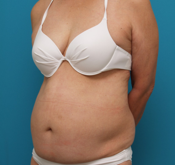 症例写真,イタリアン・メソシェイプ（イタリアンメソセラピー）・脂肪溶解注射の症例　おなか全体・ウエスト,Before,ba_meso28_b.jpg