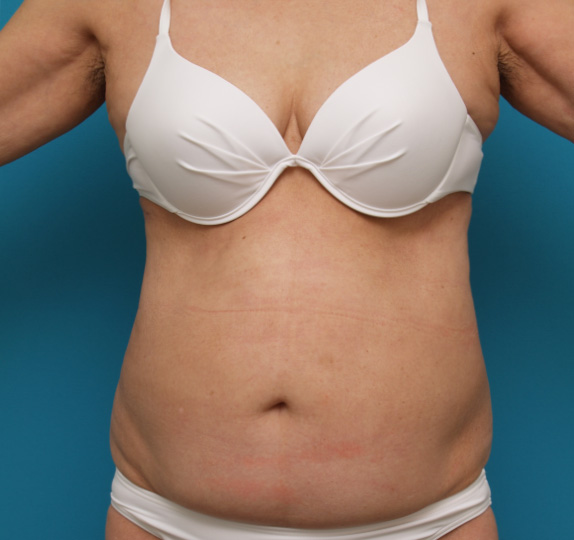 症例写真,イタリアン・メソシェイプ（イタリアンメソセラピー）・脂肪溶解注射の症例　おなか全体・ウエスト,Before,ba_meso29_b.jpg