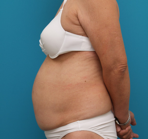 症例写真,イタリアン・メソシェイプ（イタリアンメソセラピー）・脂肪溶解注射の症例　おなか全体・ウエスト,Before,ba_meso30_b.jpg