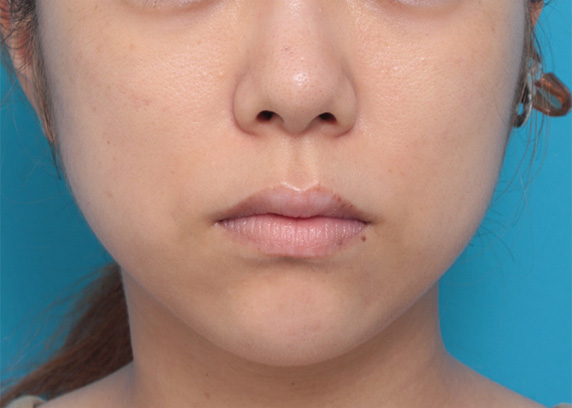 あご注射（ヒアルロン酸）,あご注射（ヒアルロン酸）症例写真　フェイスラインをシャープに,After（1ヶ月後）,ba_agochu28_b.jpg