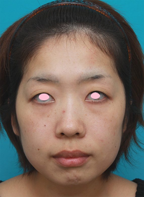 症例写真,頬とフェイスラインのイタリアン・メソシェイプ（イタリアンメソセラピー）・脂肪溶解注射で小顔になった症例写真,Before,ba_meso42_b.jpg