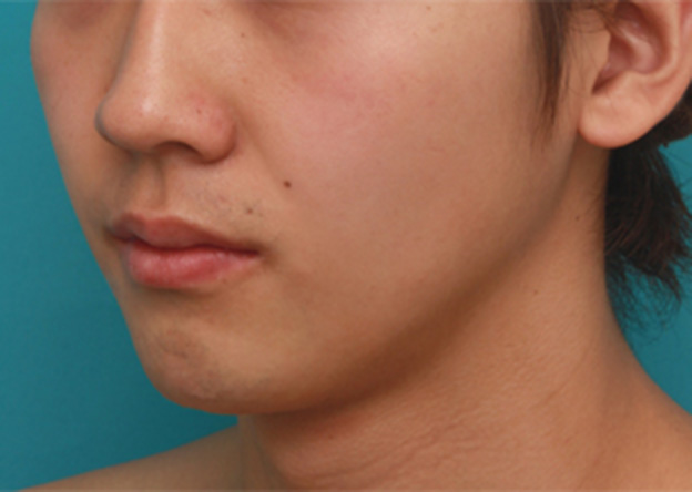 あご注射（ヒアルロン酸）,顎にヒアルロン酸注射をし、程よく尖ったシャープなフェイスラインを作った症例写真の術前術後画像,注射直後,mainpic_agochu02e.jpg