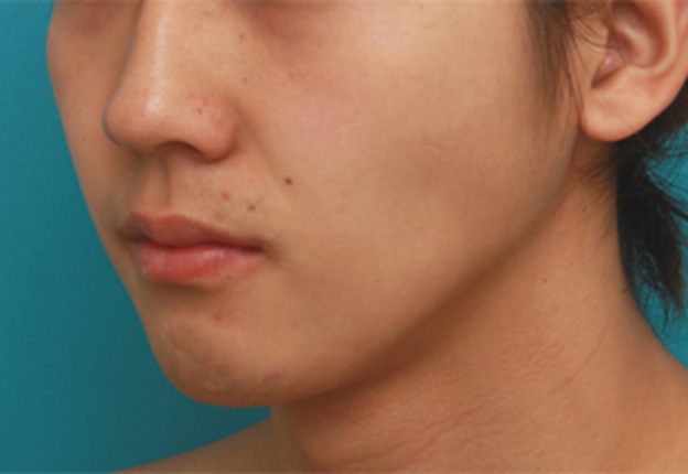あご注射（ヒアルロン酸）,顎にヒアルロン酸注射をし、程よく尖ったシャープなフェイスラインを作った症例写真の術前術後画像,1週間後,mainpic_agochu02f.jpg