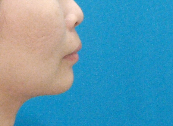二重あご改善,脂肪吸引（頬、あご）の症例 下膨れと二重あごのため年齢よりもかなり老けて見えた30代女性,After,ba_shibo04_b.jpg