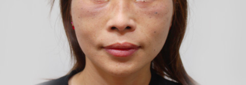 症例写真,ボツリヌストキシン注射（エラ、プチ小顔術）の症例写真 筋肉タイプのエラに,2週間後,mainpic_erabotox_b.jpg