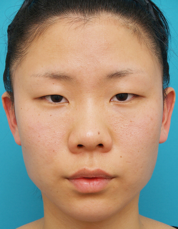 ボツリヌストキシン注射（エラ、プチ小顔術）の症例写真 筋肉タイプのエラ張りに,Before,ba_votox08_b.jpg