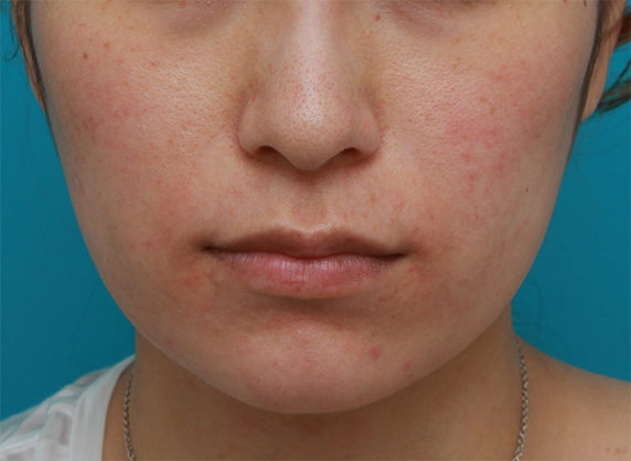 ボツリヌストキシン注射（エラ、プチ小顔術）の症例写真,After（1ヶ月後）,ba_botox01_a01.jpg