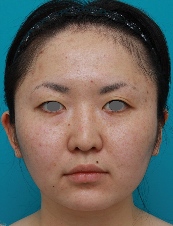 ボツリヌストキシン注射（エラ、プチ小顔術）+頬顎イタリアン・メソシェイプ（イタリアンメソセラピー）・脂肪溶解注射+顎シリコンプロテーゼ症例写真,Before,ba_botox02_b.jpg