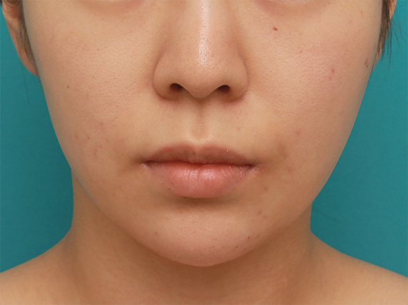 あご注射（ヒアルロン酸）,長期持続型ヒアルロン酸注射で尖った顎を作り、小顔効果を出した症例写真の術前術後画像,After（1週間後）,ba_agochu39_b.jpg