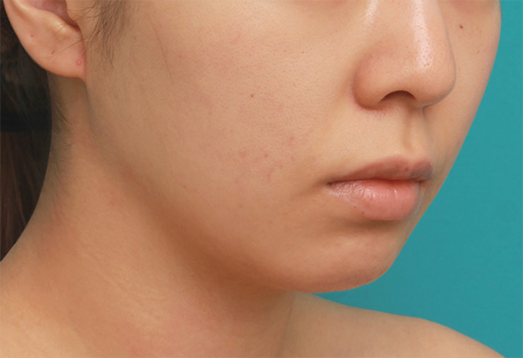 あご注射（ヒアルロン酸）,長期持続型ヒアルロン酸注射で尖った顎を作り、小顔効果を出した症例写真の術前術後画像,Before,ba_agochu40_b.jpg