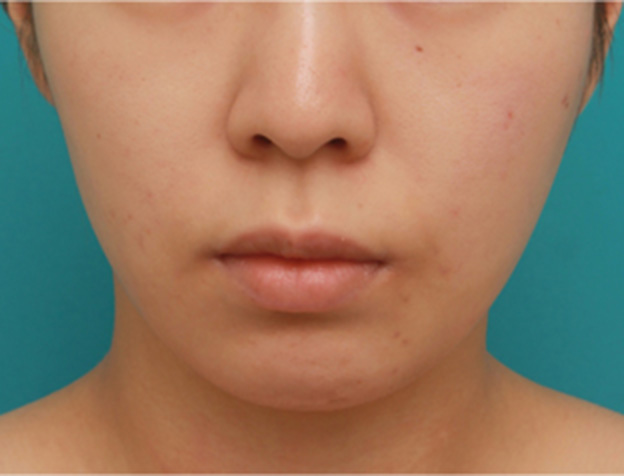 あご注射（ヒアルロン酸）,長期持続型ヒアルロン酸注射で尖った顎を作り、小顔効果を出した症例写真の術前術後画像,注射前,mainpic_agochu03a.jpg