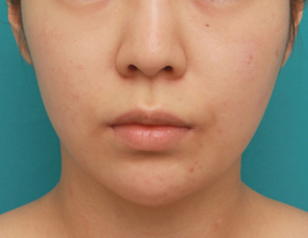 症例写真,長期持続型ヒアルロン酸注射で尖った顎を作り、小顔効果を出した症例写真の術前術後画像,注射直後,mainpic_agochu03b.jpg