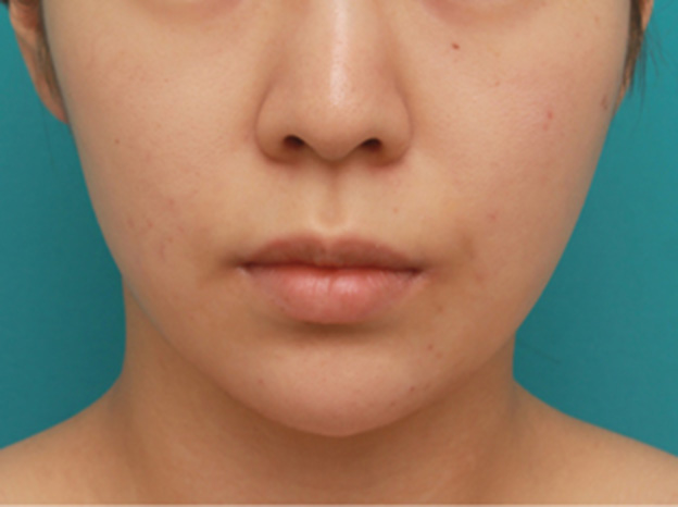 あご注射（ヒアルロン酸）,長期持続型ヒアルロン酸注射で尖った顎を作り、小顔効果を出した症例写真の術前術後画像,1週間後,mainpic_agochu03c.jpg