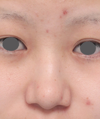 隆鼻術（シリコンプロテーゼ）,鼻尖形成（鼻尖縮小・だんご鼻修正）,鼻プロテーゼ+鼻尖形成（鼻尖縮小）症例写真,Before,ba_ryubi35_b.jpg