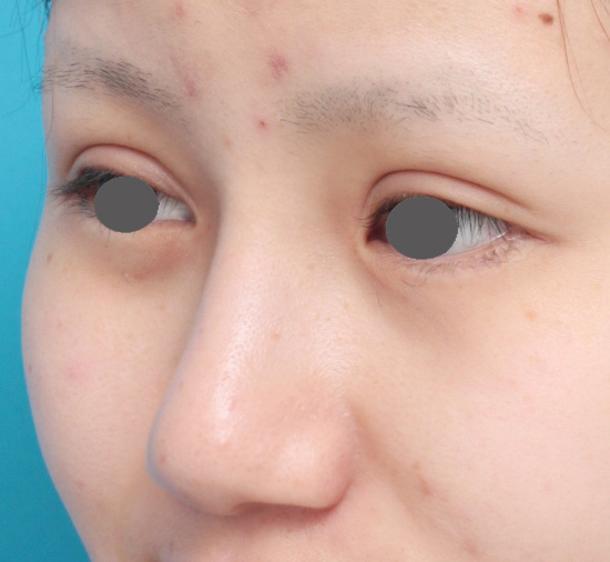 隆鼻術（シリコンプロテーゼ）,鼻プロテーゼ+鼻尖形成（鼻尖縮小）症例写真,After（メイクなし）,ba_ryubi36_b.jpg