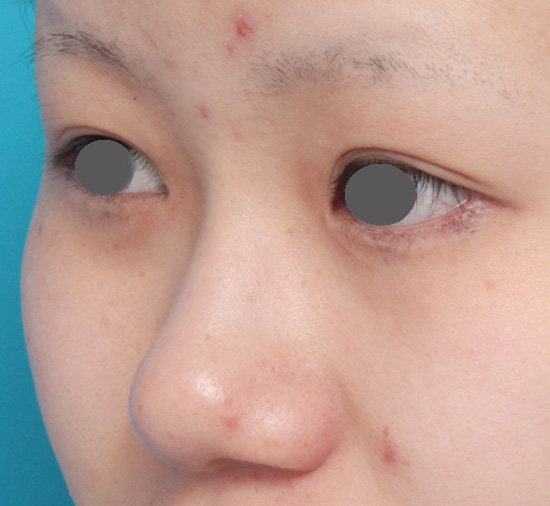 隆鼻術（シリコンプロテーゼ）,鼻プロテーゼ+鼻尖形成（鼻尖縮小）症例写真,Before,ba_ryubi36_b.jpg