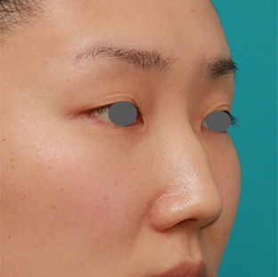 症例写真,長期持続型ヒアルロン酸注射で曲がっている鼻を真っ直ぐにし、鷲鼻を目立たなく、綺麗に鼻筋を通した20代女性の症例写真,注射前,mainpic_ryubichusha05d.jpg