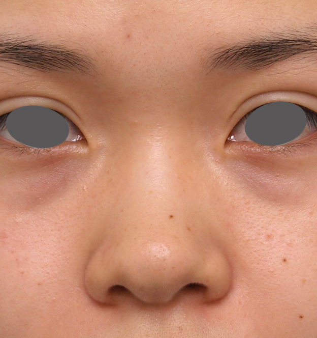 隆鼻術（シリコンプロテーゼ）,鼻プロテーゼ＋耳介軟骨移植＋鼻翼縮小症例写真,Before,ba_bisen12_b.jpg