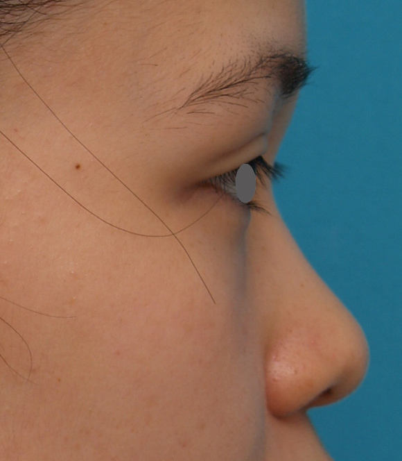鼻翼縮小（小鼻縮小）,鼻プロテーゼ＋耳介軟骨移植＋鼻翼縮小症例写真,Before,ba_bisen14_b.jpg