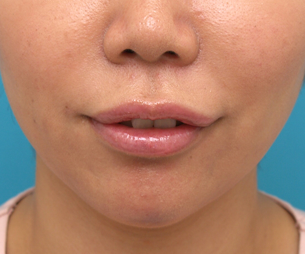 ヒアルロン酸で唇を厚く（ふっくら・アヒル口etc）,あご注射（ヒアルロン酸）,憧れてアヒル口とアゴのヒアルロン酸プチ整形した症例写真,After,ba_atsuku18_a01.jpg