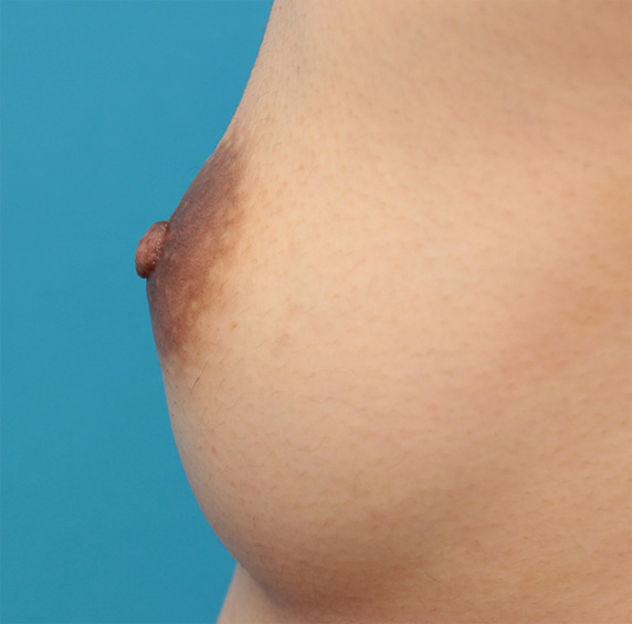 乳頭縮小,乳頭縮小手術でやや大きめな乳首を小さめにした症例写真の術前術後画像,After（3ヶ月後）,ba_nyuto32_b.jpg