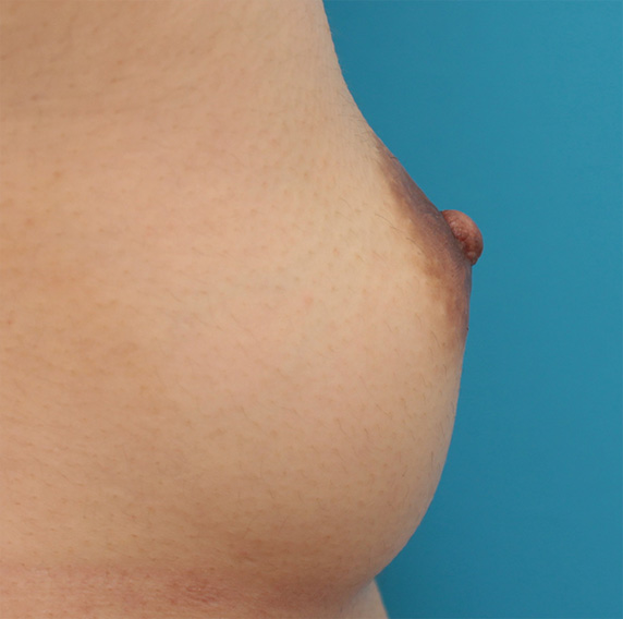 乳頭縮小,乳頭縮小手術でやや大きめな乳首を小さめにした症例写真の術前術後画像,After（3ヶ月後）,ba_nyuto33_b.jpg