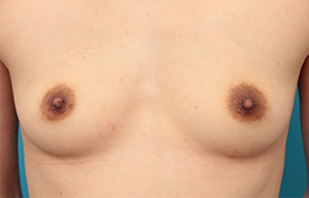 乳頭縮小,乳頭縮小手術でやや大きめな乳首を小さめにした症例写真の術前術後画像,10日後,mainpic_nyuto05c.jpg