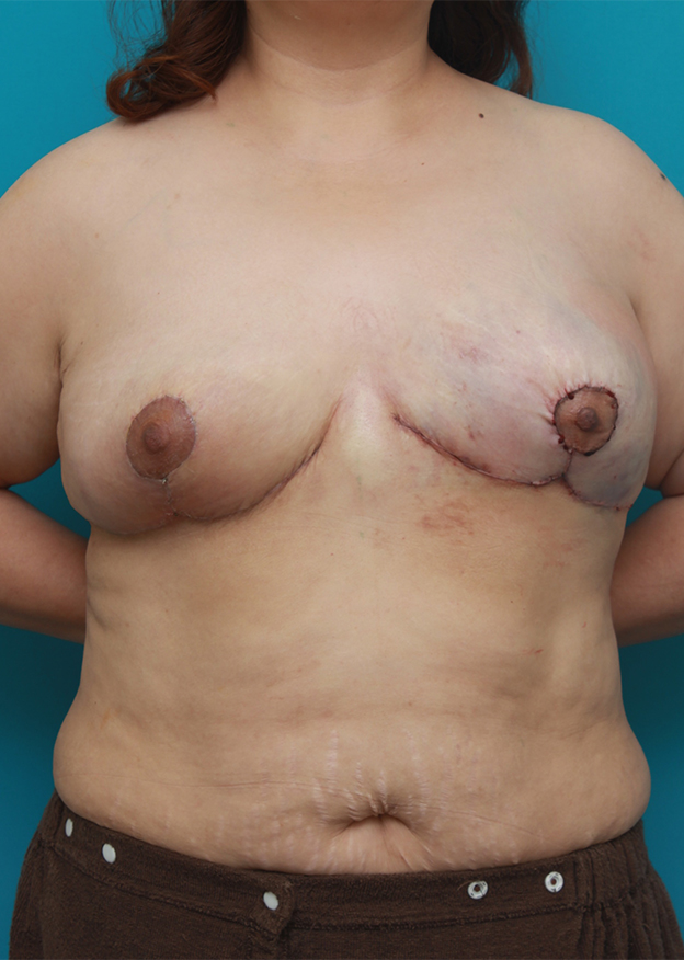 乳房縮小手術（マンマリダクション）,乳房縮小手術（マンマリダクション）の症例　2週間空けて片胸ずつ手術,左側手術直後,mainpic_shukusho01d.jpg