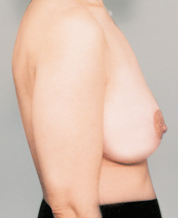 下垂乳房形成（垂れ乳修正）,下垂乳房形成（垂れ乳修正）の症例 加齢により胸が垂れてしまった女性,After,ba_tare05_a01.jpg