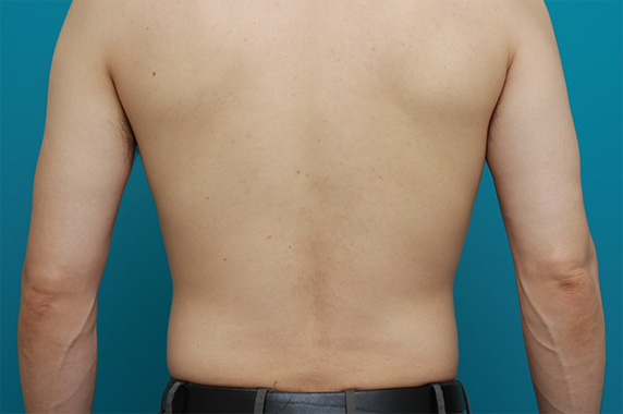 イタリアン・メソシェイプ（イタリアンメソセラピー）・脂肪溶解注射,30代男性の背中・ウエスト・腰・臀部にイタリアン・メソシェイプ（イタリアンメソセラピー）・脂肪溶解注射を行った症例写真,After（6回目注射後2ヶ月）,ba_meso48_b.jpg