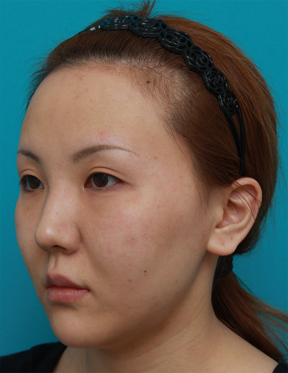 イタリアン・メソシェイプ（イタリアンメソセラピー）・脂肪溶解注射,頬、顎にイタリアン・メソシェイプ（イタリアンメソセラピー）・脂肪溶解注射を3回行い、小顔になった症例写真,After（3回目終了後2ヶ月後）,ba_meso50_b.jpg