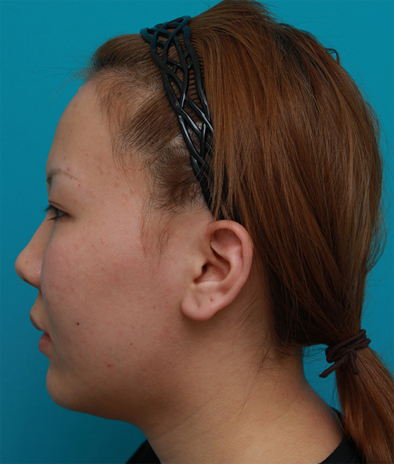 症例写真,頬、顎にイタリアン・メソシェイプ（イタリアンメソセラピー）・脂肪溶解注射を3回行い、小顔になった症例写真,Before,ba_meso51_b.jpg