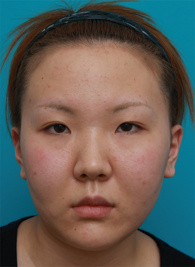 症例写真,頬、顎にイタリアン・メソシェイプ（イタリアンメソセラピー）・脂肪溶解注射を3回行い、小顔になった症例写真,治療前,mainpic_meso05a.jpg